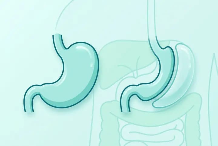 Bariatric Surgery