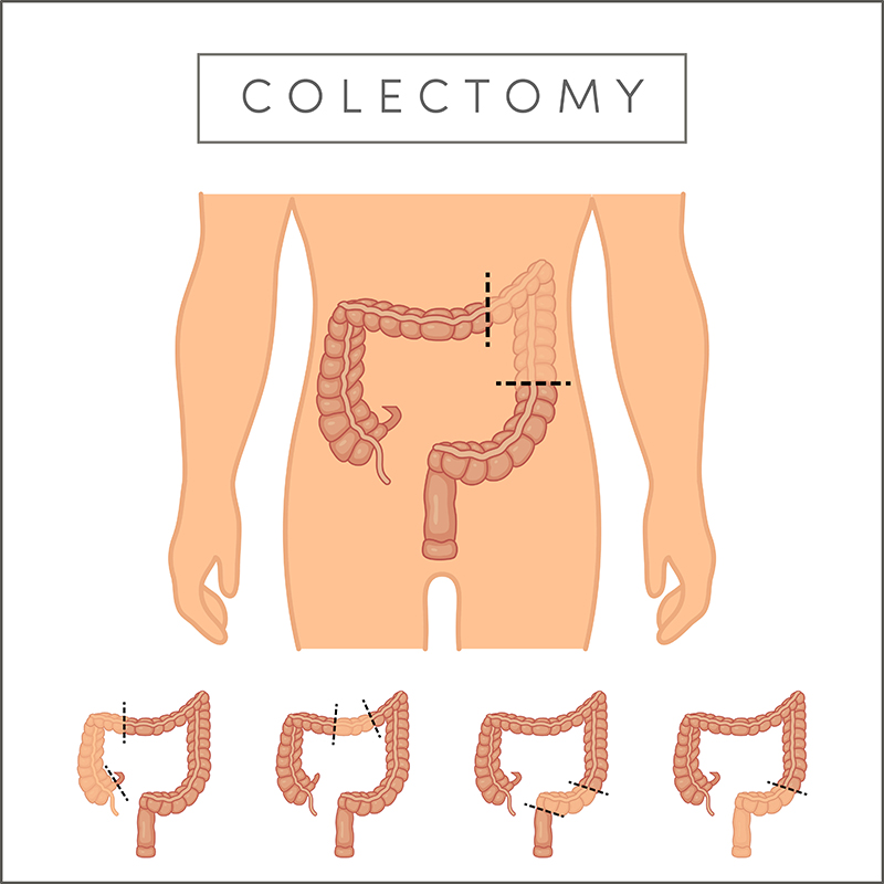 Small and Large Intestine Surgery