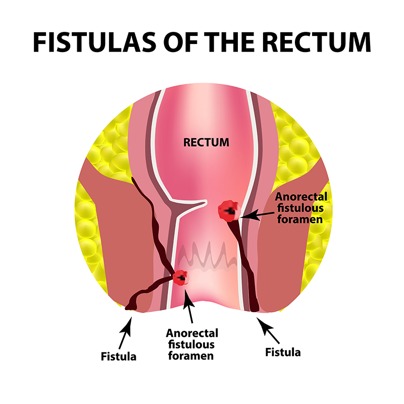 Anal Fistula Formation