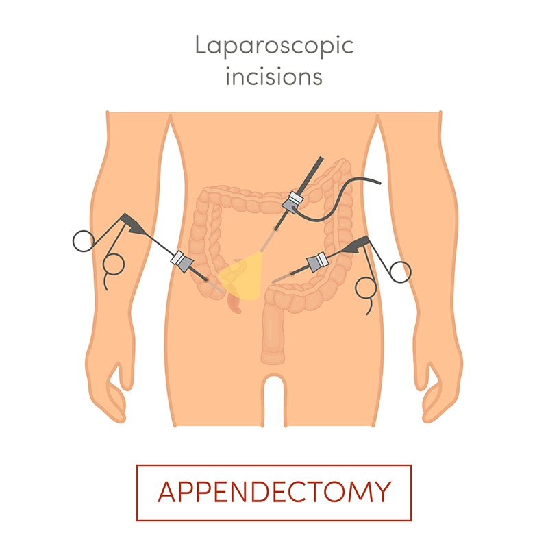 Laparoscopic Appendectomy