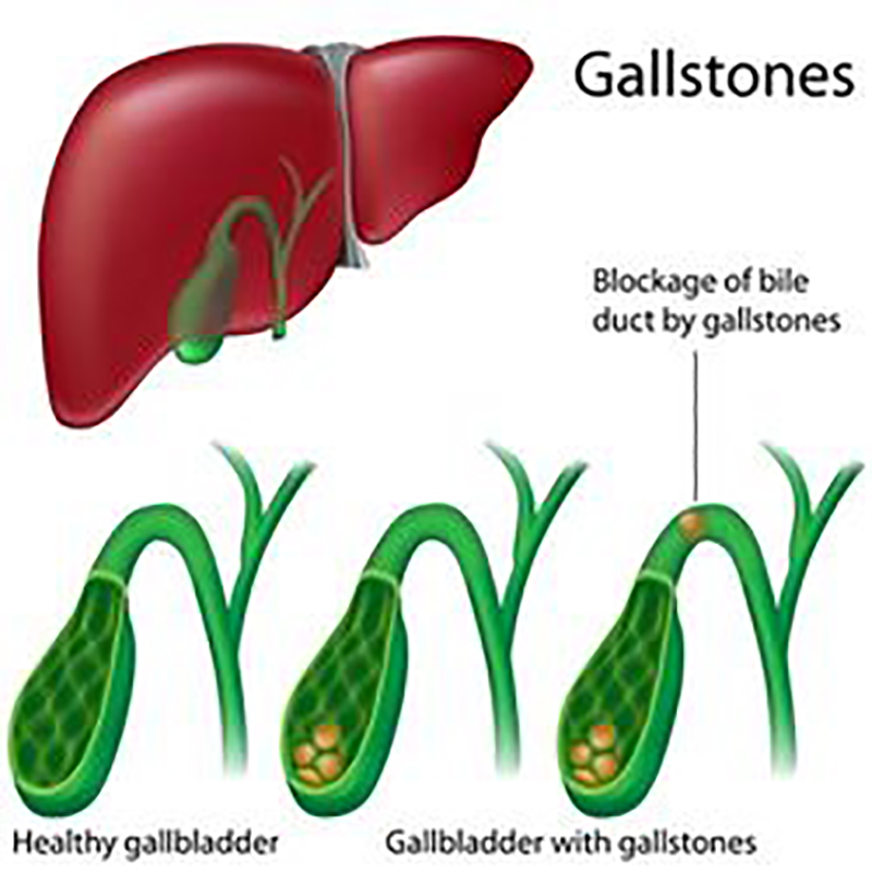 Gall Stones Formation
