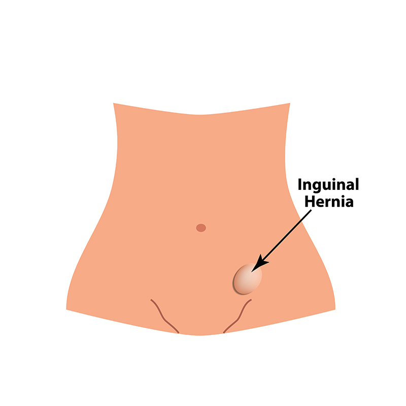 Inguinal Hernia Treatment