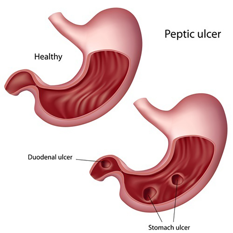 Peptic Ulcers Treatment