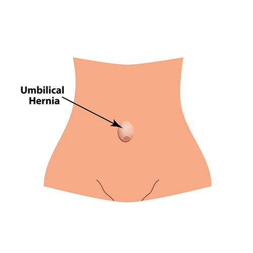 Umbilical Hernia Treatment
